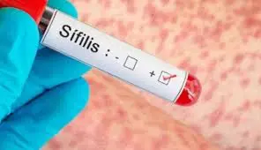 Mendoza lanza la campaña “Decí Sífilis” para promover la prevención y el diagnóstico temprano